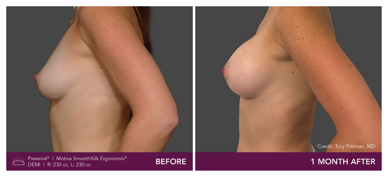 Patient Preserve Before and Afters Demi Projection Side View