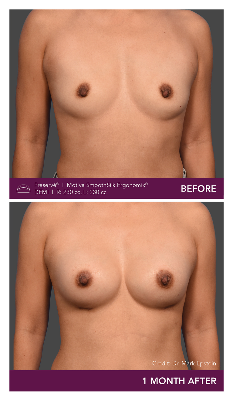 Patient Preserve Before and Afters Demi Projection Front View Mobile