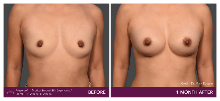 Patient Preserve Before and Afters Demi Projection Front View