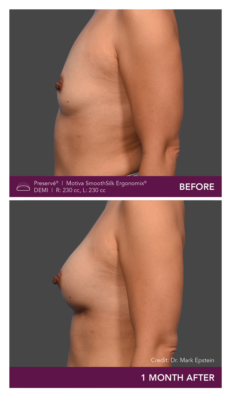 Patient Preserve Before and Afters Demi Projection Side View Mobile