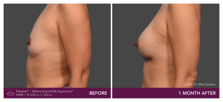 Patient Preserve Before and Afters Demi Projection Side View