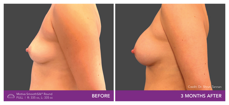 Dr. Shruti Tannan - Patient BR - Side